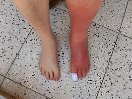 Cellulitis van linkerbeen